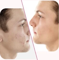 Merkloos Pimple Patch - Acne Patch - Puisten Patch - Acne Sticker - Puisten Pleister - Pimple Patches - Acne Pleister - Puisten Verwijderaar - Puisten Creme - Acne Verwijderen Set - Acneverzorging | 36 Stuks & Directe Levering -Verzorgingsvoordeel Huis 1176x1200 10