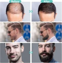 Dermaroller 0.5 Mm & Desinfectie Alcohol Spray - 540 Naalden - Steriel Verpakt -Verzorgingsvoordeel Huis 1190x1200 15