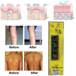 Psoriasis/exzeem Chineese Creme -Verzorgingsvoordeel Huis 1195x1200 1