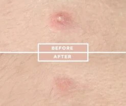 COSRX Acne Pimple Master 32 COSRX Acne Pimple Master -Verzorgingsvoordeel Huis 1200x1008 2