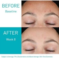 CeraVe Resurfacing Retinol Serum Tegen Restlittekentjes En Zichtbare Poriën, Voor Onzuivere Huid Met Neiging Tot Acne - 30 Ml -Verzorgingsvoordeel Huis 1200x1188 8