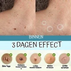 Skini™ - Moedervlekken & Wratten & Skin Tags Verwijderaar | Moedervlekken Verwijderaar | Wratten Verwijderaar | Moedervlekken Verwijderen | Wratten Verwijderen | Fibroom Verwijderen | Skin Tag Verwijderen | Steelwratjes Verwijderen 5 Skini™ - Moedervlekken & Wratten & Skin Tags Verwijderaar | Moedervlekken Verwijderaar | Wratten Verwijderaar | Moedervlekken Verwijderen | Wratten Verwijderen | Fibroom Verwijderen | Skin Tag Verwijderen | Steelwratjes Verwijderen -Verzorgingsvoordeel Huis 1200x1200 40