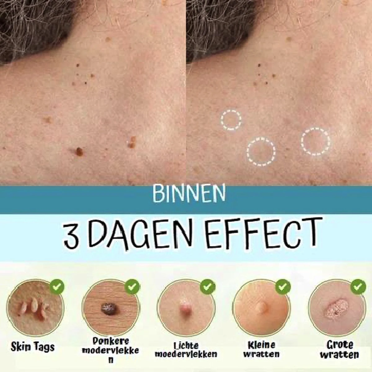 Skini™ - Moedervlekken & Wratten & Skin Tags Verwijderaar | Moedervlekken Verwijderaar | Wratten Verwijderaar | Moedervlekken Verwijderen | Wratten Verwijderen | Fibroom Verwijderen | Skin Tag Verwijderen | Steelwratjes Verwijderen 3 Skini™ - Moedervlekken & Wratten & Skin Tags Verwijderaar | Moedervlekken Verwijderaar | Wratten Verwijderaar | Moedervlekken Verwijderen | Wratten Verwijderen | Fibroom Verwijderen | Skin Tag Verwijderen | Steelwratjes Verwijderen - Afbeelding 3