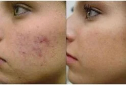 Merkloos Dermaroller 0.3mm Needle - Micro Needling Roller - Anti Acne/Cellulitis/Rimpels/Littekens/Striae Lichaams & Gezichts Roller -Verzorgingsvoordeel Huis 1200x809 5